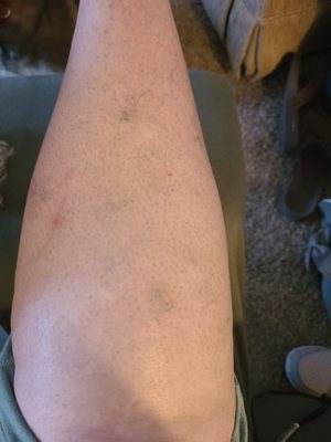 I am 60 years old. Varicose veins are not a laughing matter