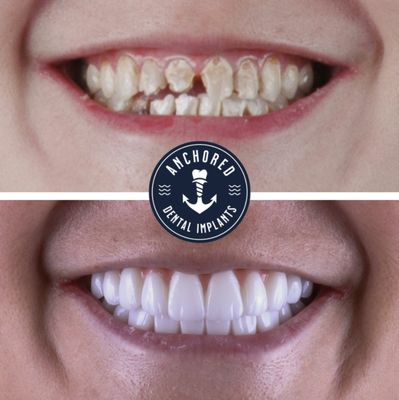 Full Mouth Dental Implants Before and After