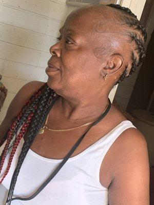 Large Braids on Alopecia