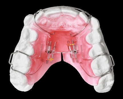 3 Way Ex fabricated in the USA by David Gergen from Gergen's Orthodontic Lab