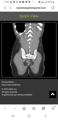 Image of rectal intussuception herniating into prostate and adjacent structures