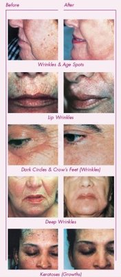 Wrinkles: Laser Skin Resurfacing Before & After