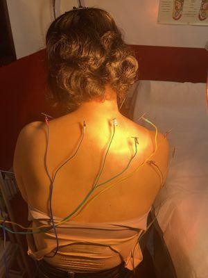 Acupuncture for shoulder pain.