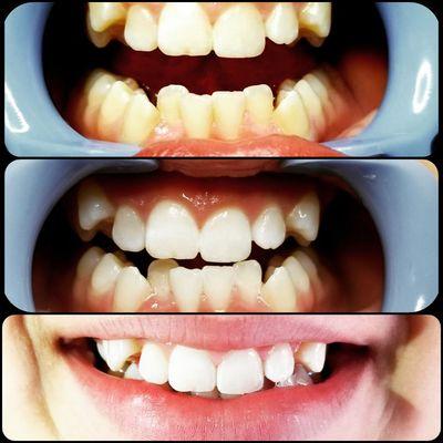 Three Session Teeth Whitening