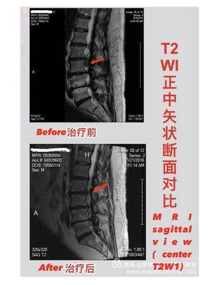 The same  patient's  MRI images were comparing after the 8 treatments