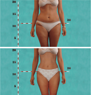 Notice the skin is tighter and more firm as well as the over all reduction in circumference of the abdominal area