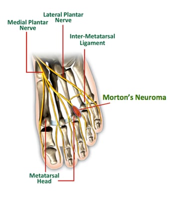 What is Morton's neuroma?