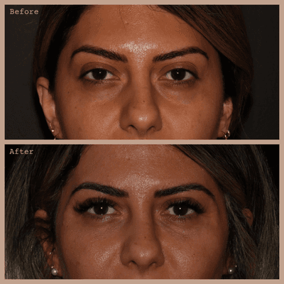 Under Eyes Filled with Hyaluronic Acid Filler