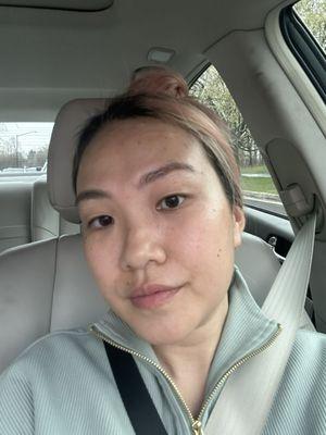 Before the treatment: my face has uneven skin tone and dark spots.