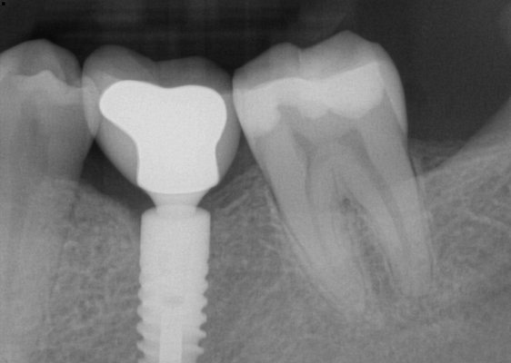 Implant Case