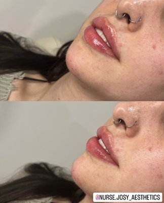 LIP + CHIN FILLER