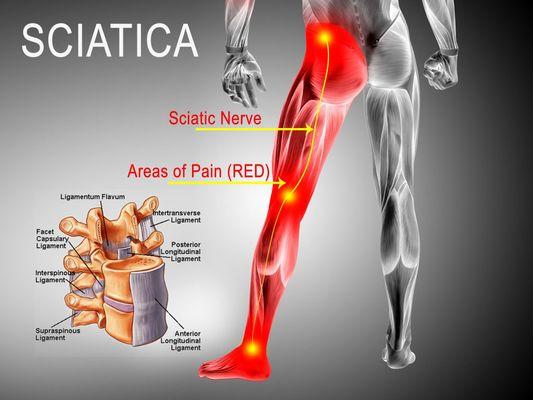 Acupuncture  is a highly promising treatment for sciatica pain relief.