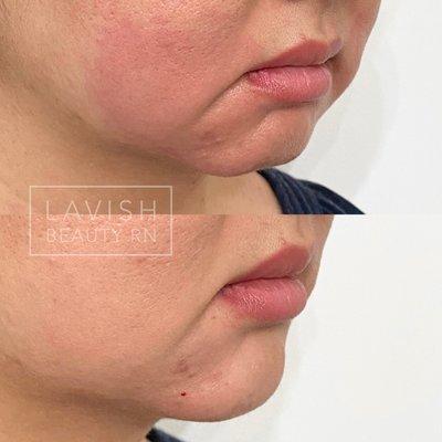 Chin fillers to provide facial symmetry