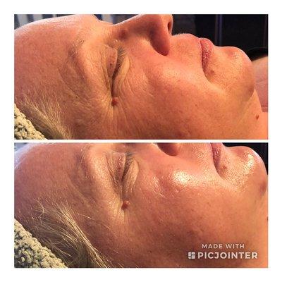 Hydrafacial before and after one treatment.