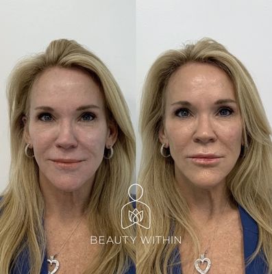 Before and After Facial Balancing