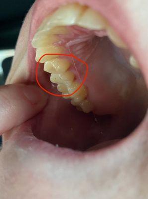 Inside view of right bicuspids with flatter surface. They used to look almost exactly the same as the left bicuspids.