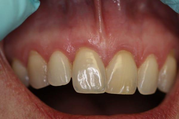 After gum graft procedure