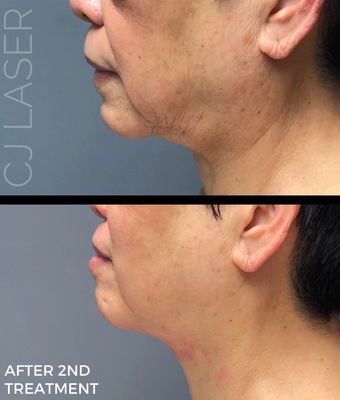 Our clients results after 2 sessions of Laser Lift!