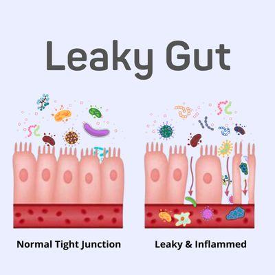 Leaky gut syndrome can cause diarrhea, bloating, abdominal pain, food allergies, and skin issues.