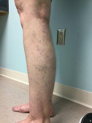 After our VeinErase procedure, the large cluster of veins behind her knee and along her calf were completely gone.