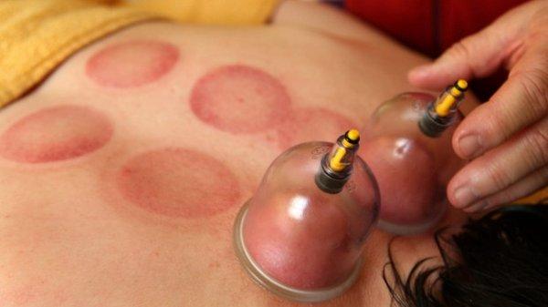 The addition of Cupping Therapy to a massage provides painless deep tissue release four inches into the muscle’s surface.