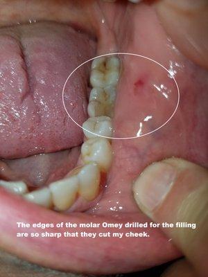 This shows the slice in my cheek from the sharp edges of the molar Omey drilled on.