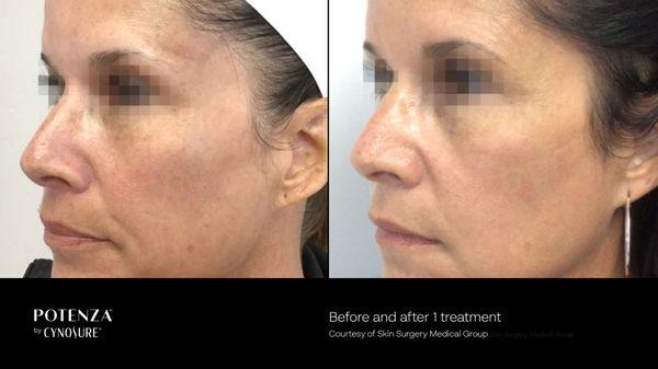 Before and after- Potenza microneedling with RF