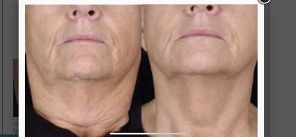 Skin Tightening by Vivace RF Microneedling (2 Treatments)