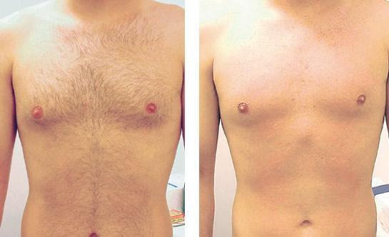 Upper body hair no more! For the Hollywood look you've been wanting :)