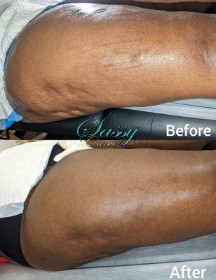 Cellulite removal