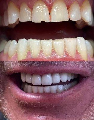 One of Dr. Boniadi's beautiful smile transformations on our amazing patient!