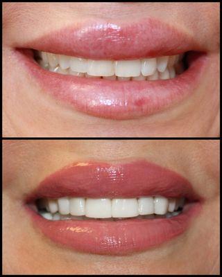 Veneers