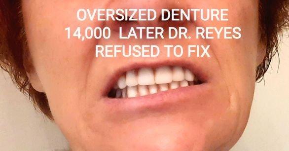 This is what a new denture from Dr. Reyes looks like. Awful  Clear choice dental is correcting his mistakes he's not qualified