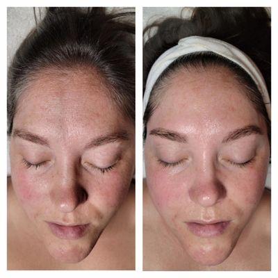 Before & After Jacqueline's Custom Resurfacing Facial with Brow Wax & Tint