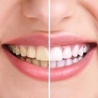 Whiten your teeth up to 8 shades lighter - teeth whitening just $129.