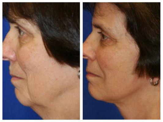 Neck Lift Before and After Results by Haven J. Barlow, MD, FACS