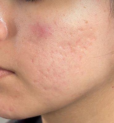 Fibro blast plasma treatment for acne scars