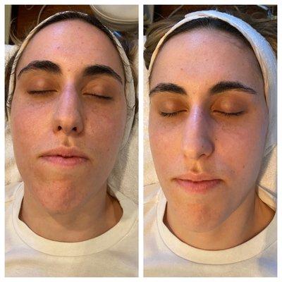 Carbon Mask Facial