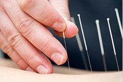 Acupuncture