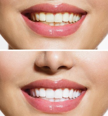 Teeth Whitening Difference