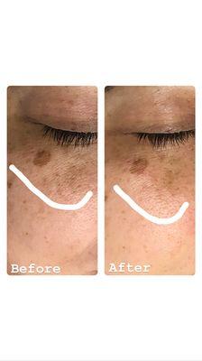 Microdermabrasion combined with a light chemical peel for dark spots.