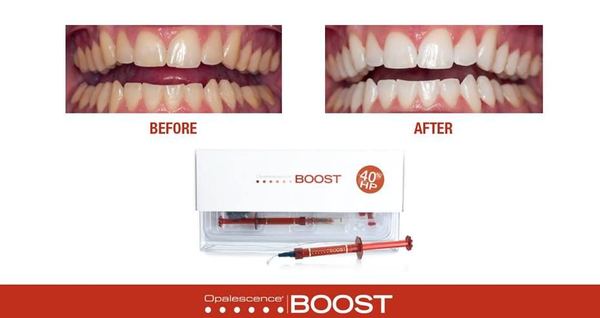 Our preferred in house whitening system