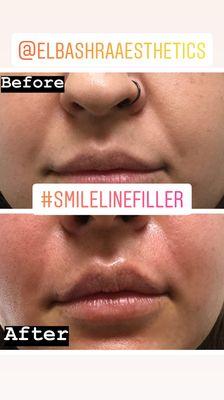 Smile line filler