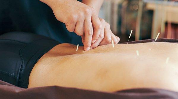 Acupuncture In Hartford And Springfield