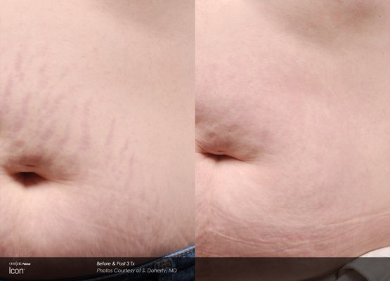 Laser improve stretch marks, as shown on this before and after pictures