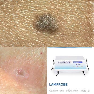 Remove Keratosis with a Lamprobe Treatment