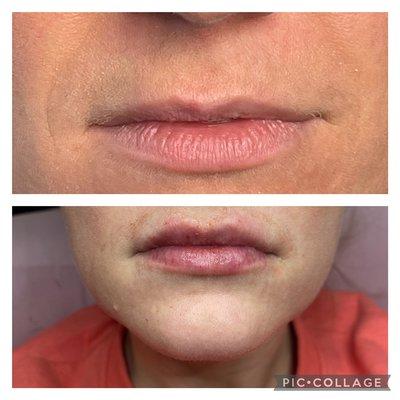 2ml needle free lip filler