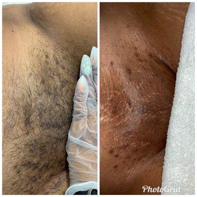 Brazilian Waxing