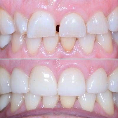 Diastema closure and smile transformation achieved by utilizing IPS e.max crowns.