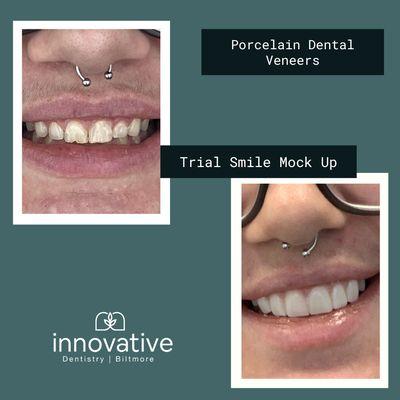 All cosmetic work at Innovative Dentistry Biltmore includes trying on your new smile before the teeth are even touched.